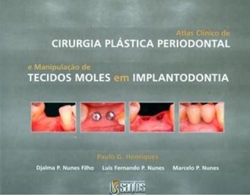 Atlas Clínico de Cirurgia Plástica Periodontal